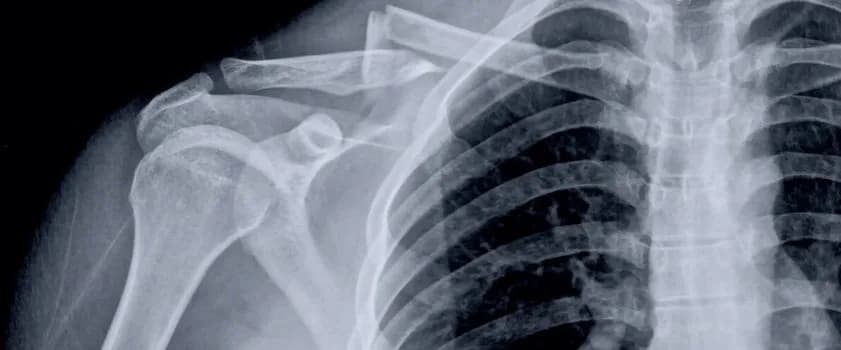 Złamany obojczyk - Wskazania do operacji i przebieg leczenia Złamany obojczyk - Wskazania do operacji i przebieg leczenia