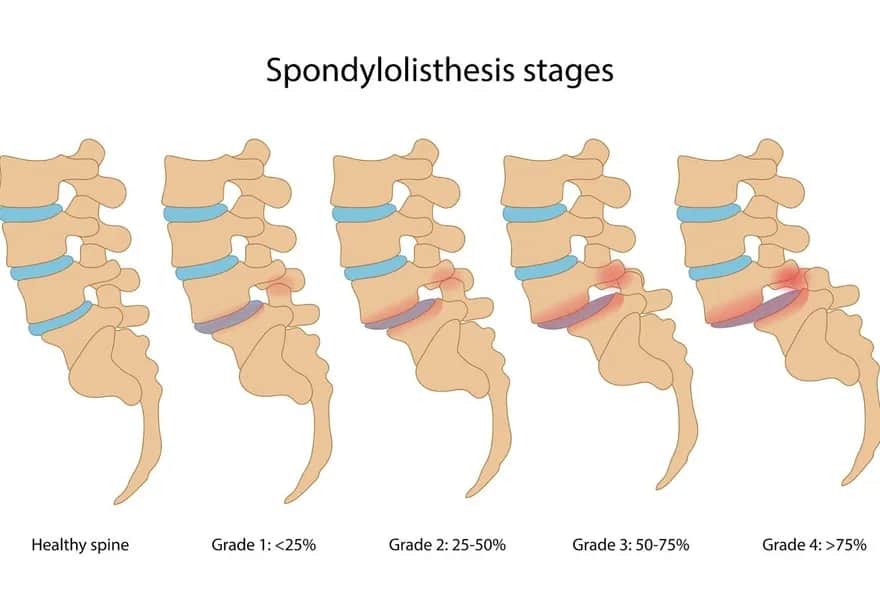 Co oznacza kręgozmyk 8mm i jak podejść do leczenia?