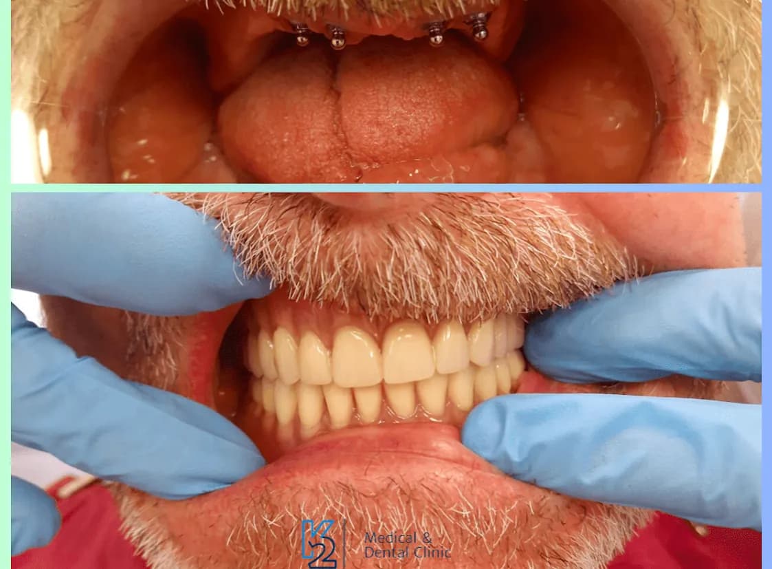 Implanty zębowe jako klucz do zdrowego uśmiechu