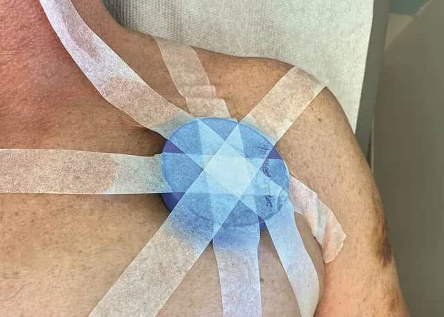 Wymiana baterii w rozruszniku serca - jak wygląda zabieg?